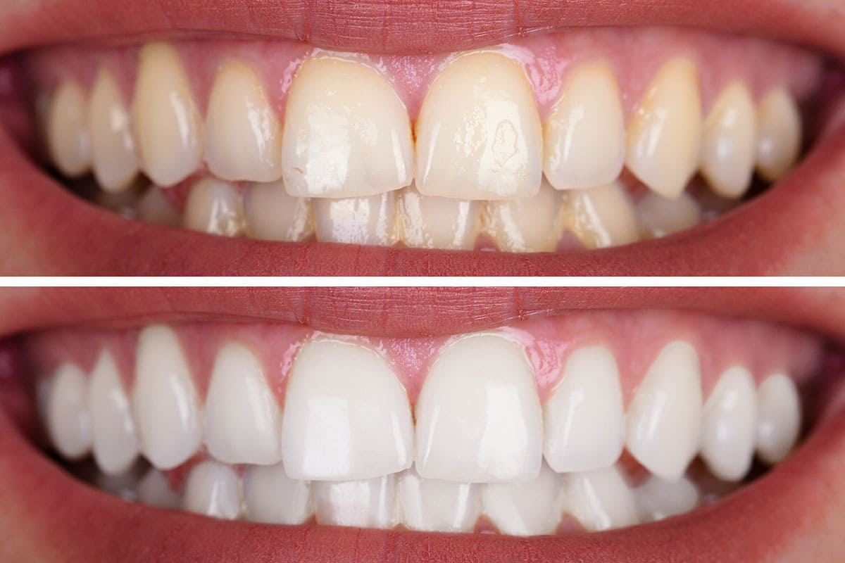 A before and after shot of whitening your teeth. 